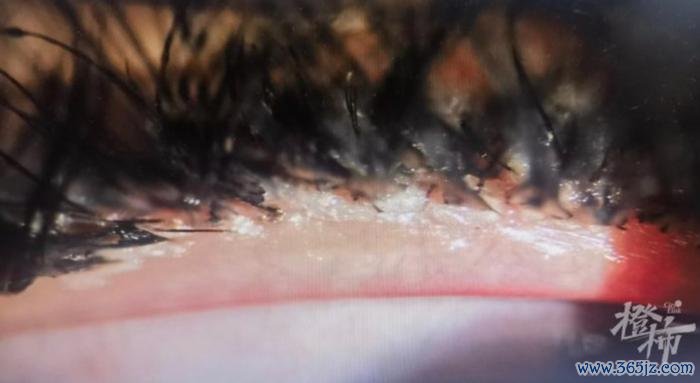 裂隙灯显微镜下像片露出睫毛根部(睑缘)充血、沾满了胶水